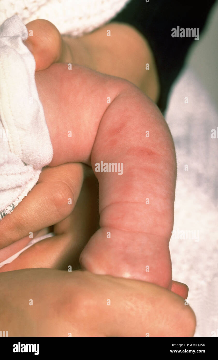 Bambino - burn (non lesioni accidentali) Foto Stock