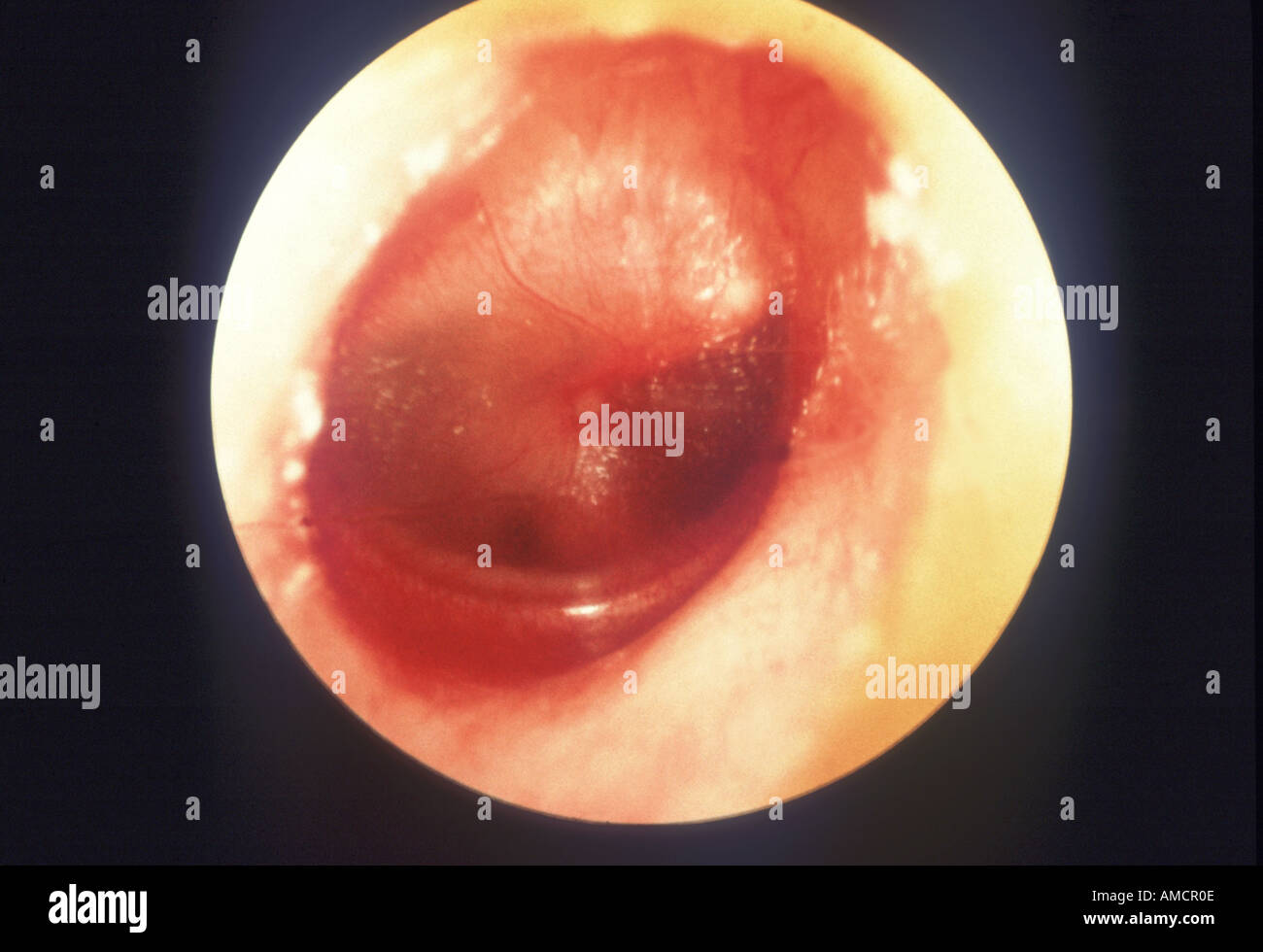 Otite media Foto Stock