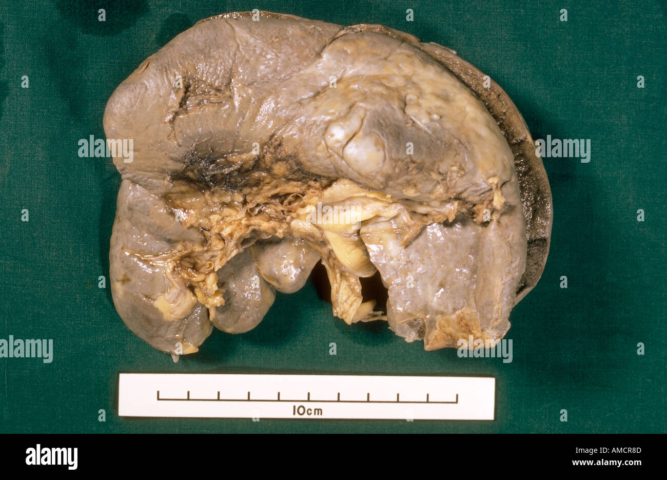 Una fotografia di un campione di fegato che mostra segni di cirrosi epatica Foto Stock