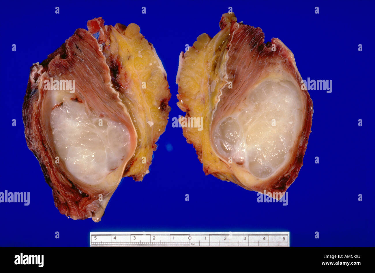 Una fotografia di un escisso soft tissue sarcoma, maligno (cancerosi) che si sviluppano nel tessuto morbido. Foto Stock