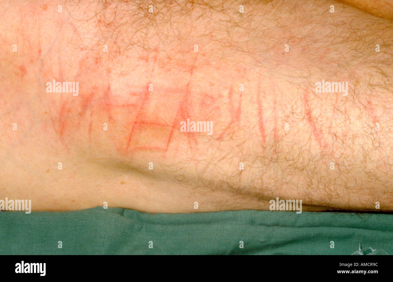 Una fotografia di un paziente con graffi sulla coscia a causa di un'auto-danneggiare Foto Stock