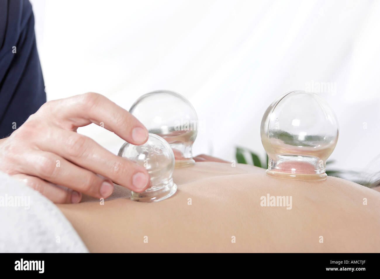 Donna di ricezione di agopuntura cupping metà sezione Foto Stock
