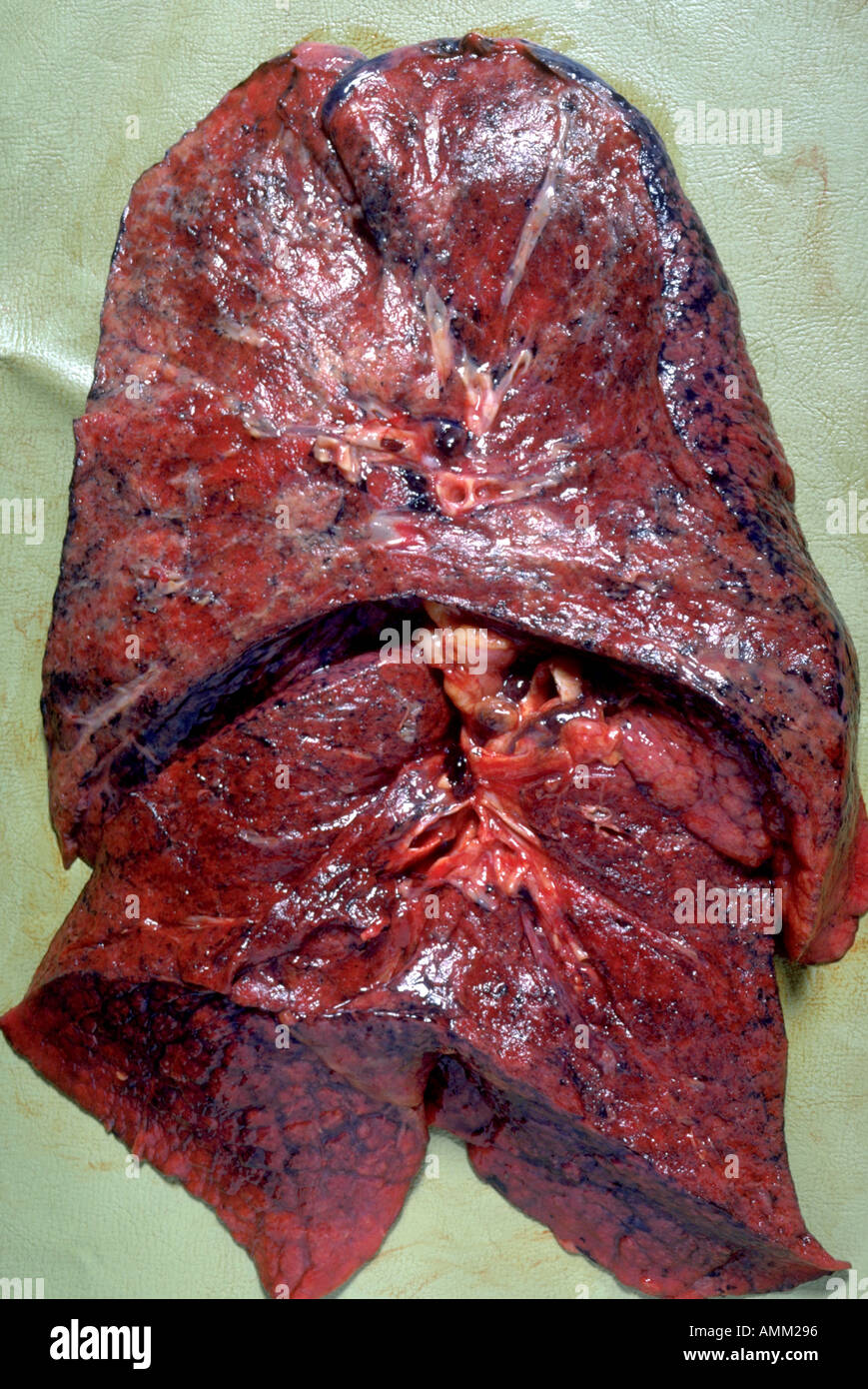 Campione di polmone fibrosing alveoliti Foto Stock