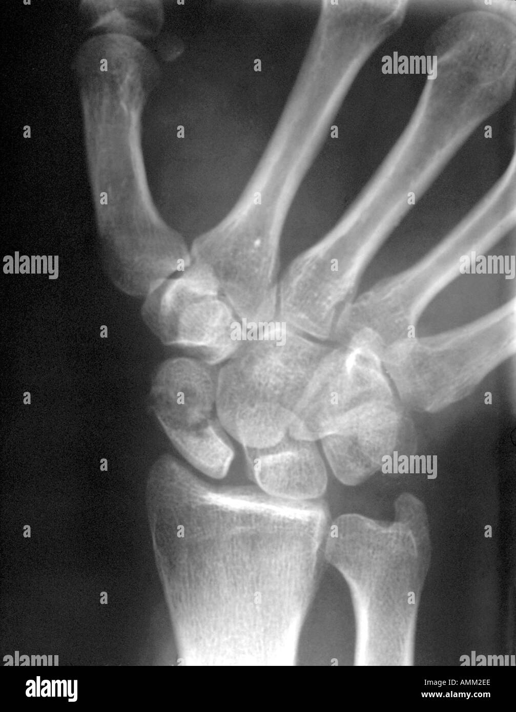 X ray scafoide fratturato Foto Stock