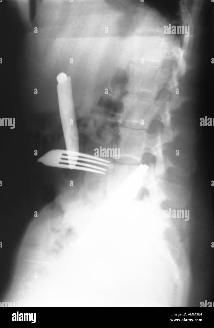 X ray di ingestione di corpi estranei Foto Stock
