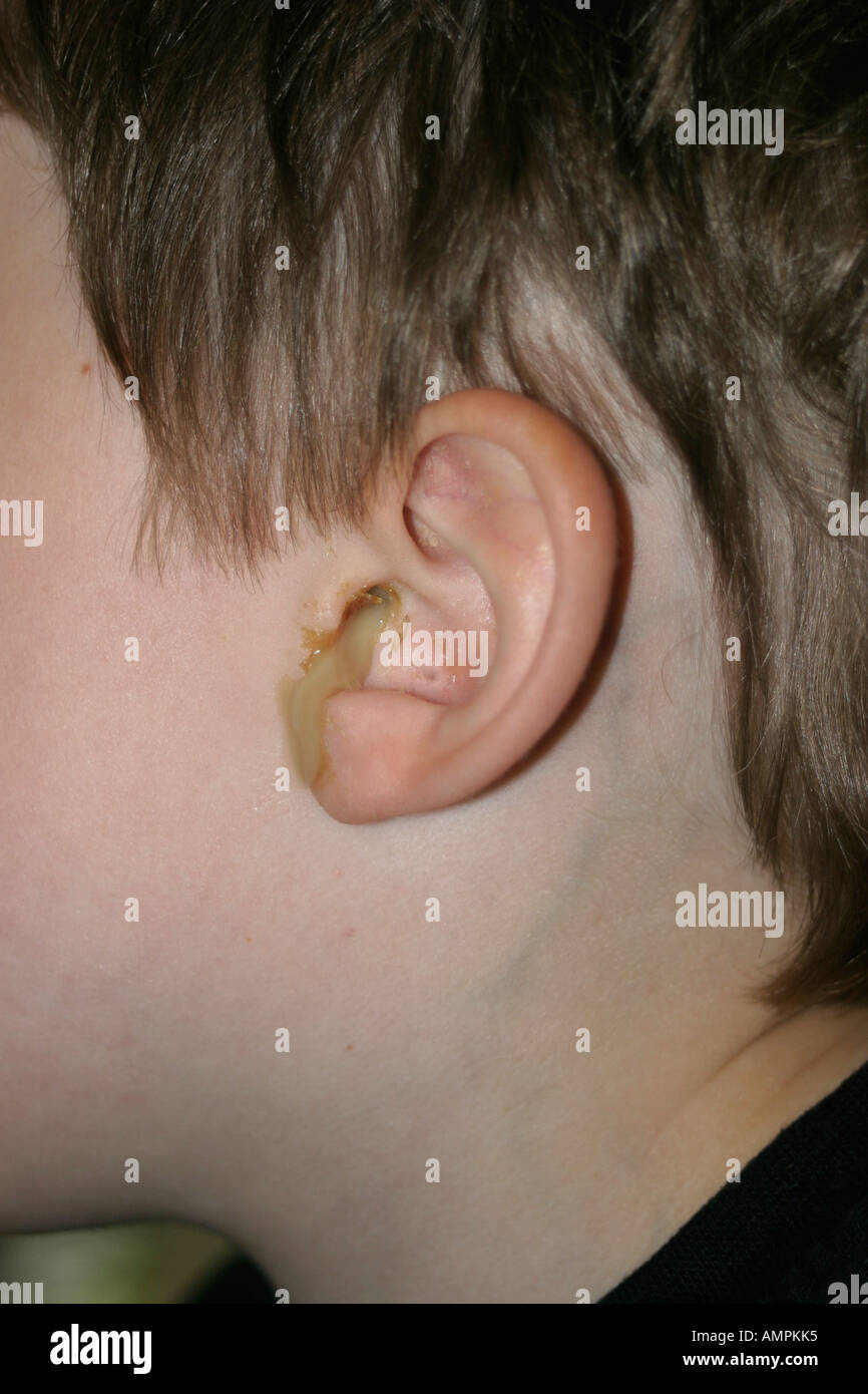 Otite media orecchio sinistro lo scarico sembra molto inquietante Foto Stock