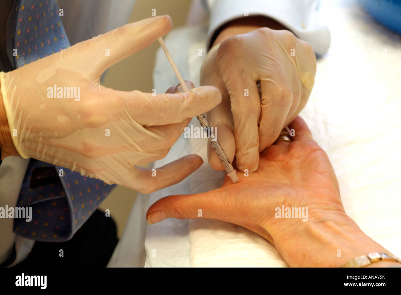 Iniezione strumento chirurgico e pazienti mano essendo iniettato con il Triamcinolone Foto Stock