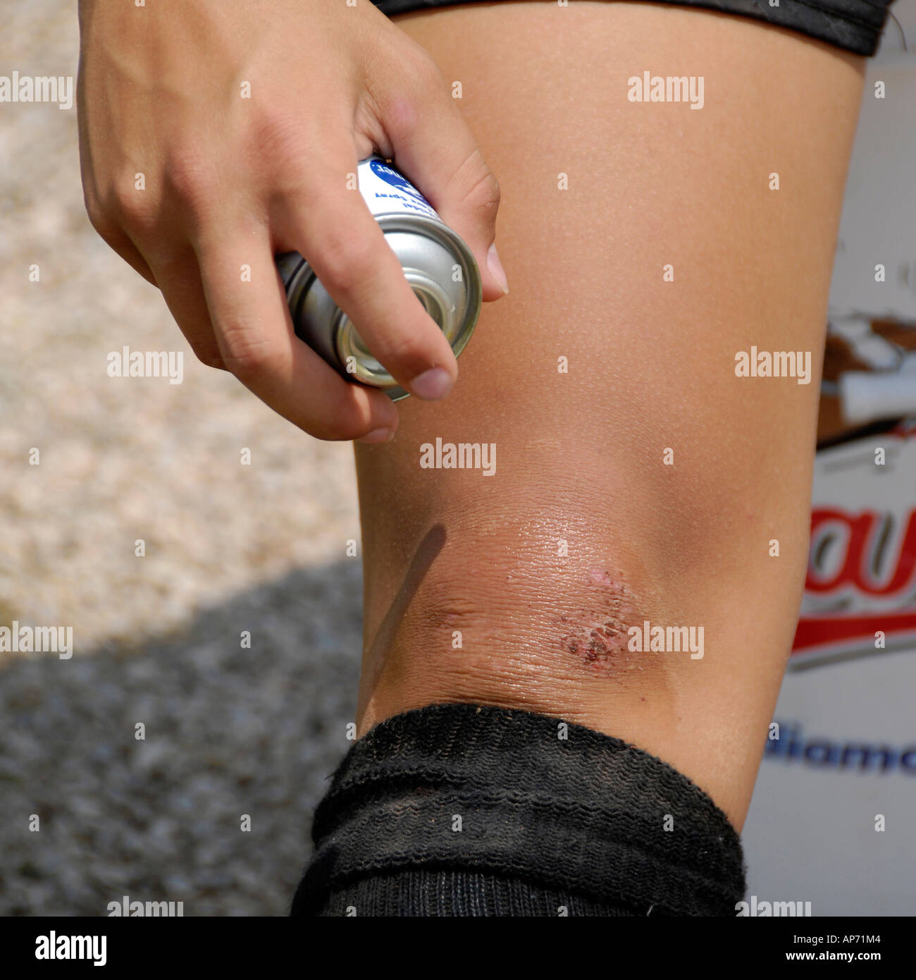 Player copre raschiare con nuova pelle dallo sport pregiudizio dovuto alla riproduzione di baseball Foto Stock