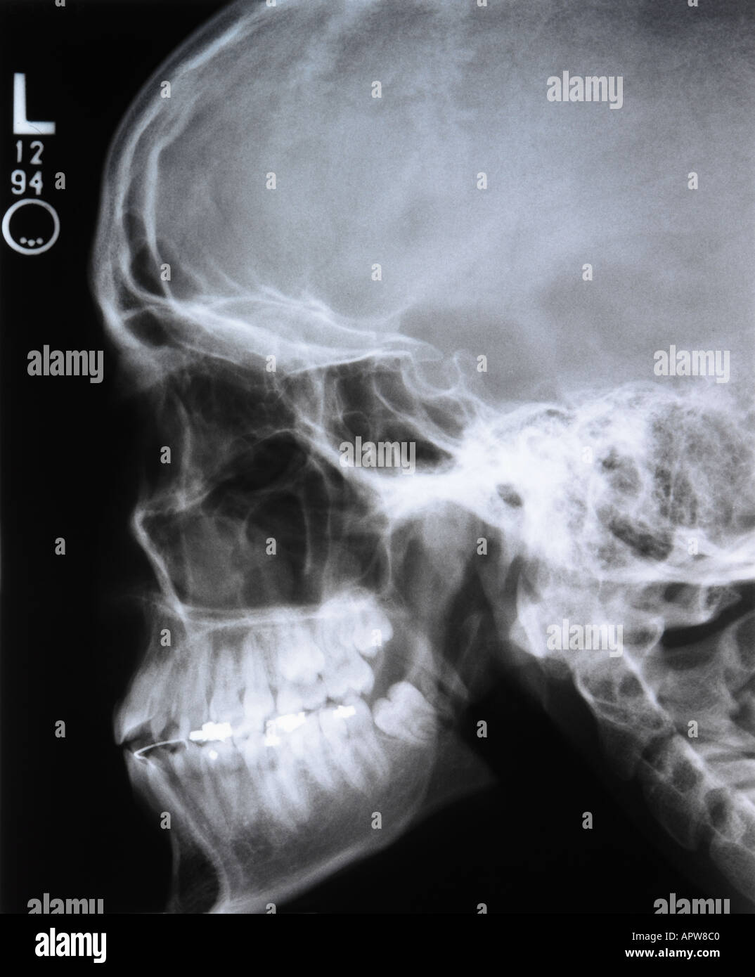 Immagine avanzata di un teschio umano X Ray Foto Stock