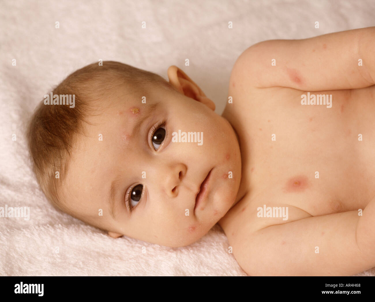 Bambina con varicella sul viso e sul petto, virus, Inghilterra, inglese,  britannico, Regno Unito Foto stock - Alamy