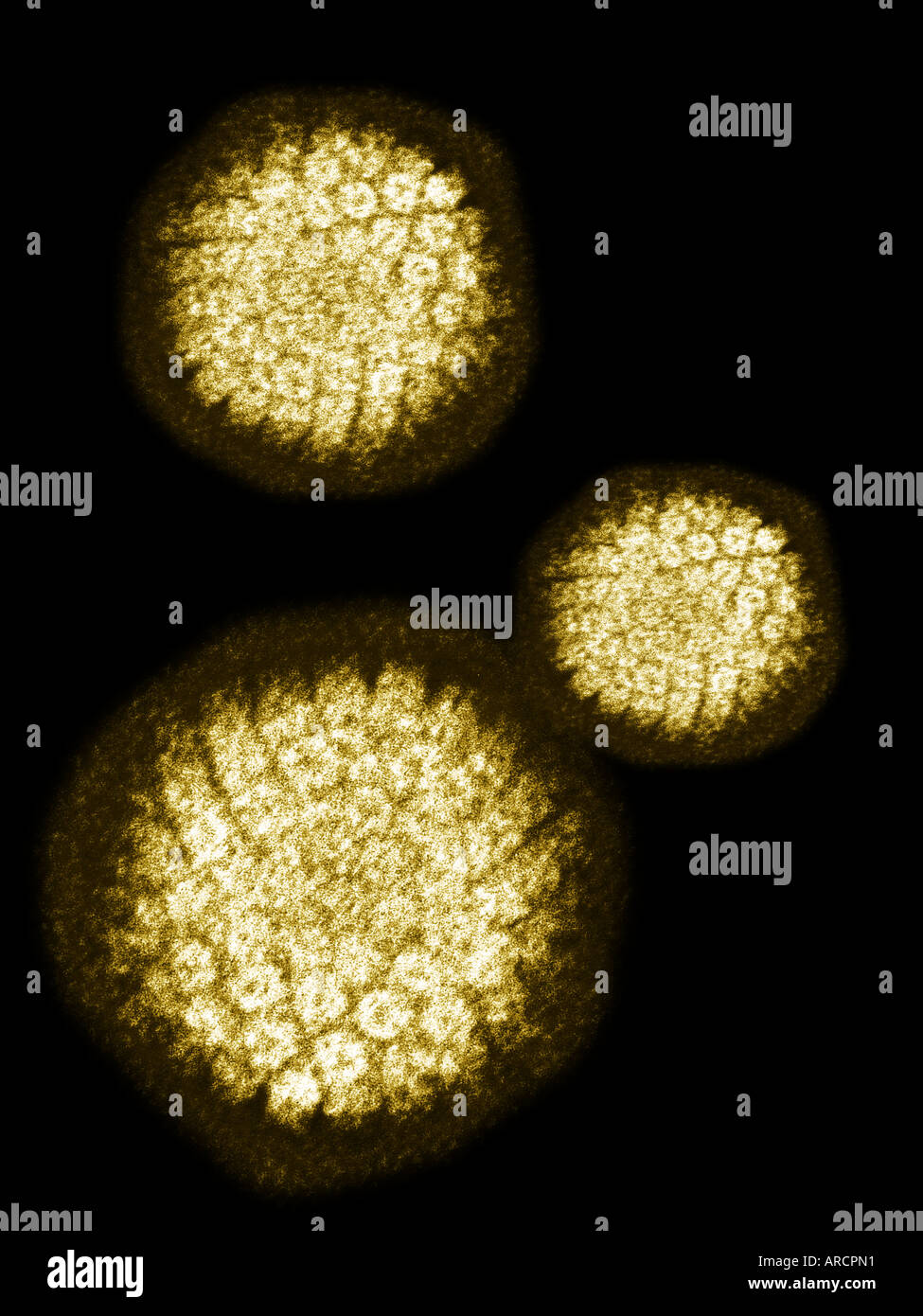 Transmissione micrografia elettronica (TEM) di un colorato negativamente il virus del papilloma umano (HBV) che provoca le verruche Foto Stock