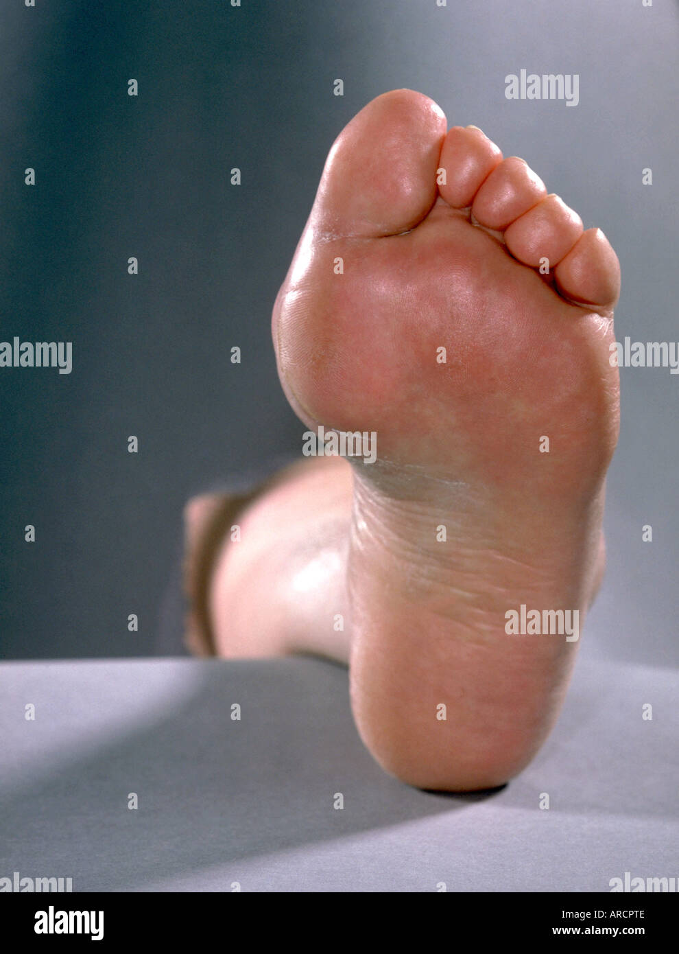 Il gonfio al piede di un paziente con la gotta, noto anche come acido urico artropatia Foto Stock