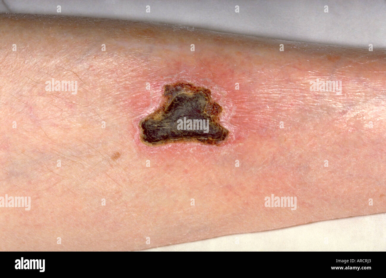 Bollose o vesciche farmaco eruzioni sono tra le più gravi tipi di reazioni avverse al farmaco. Foto Stock