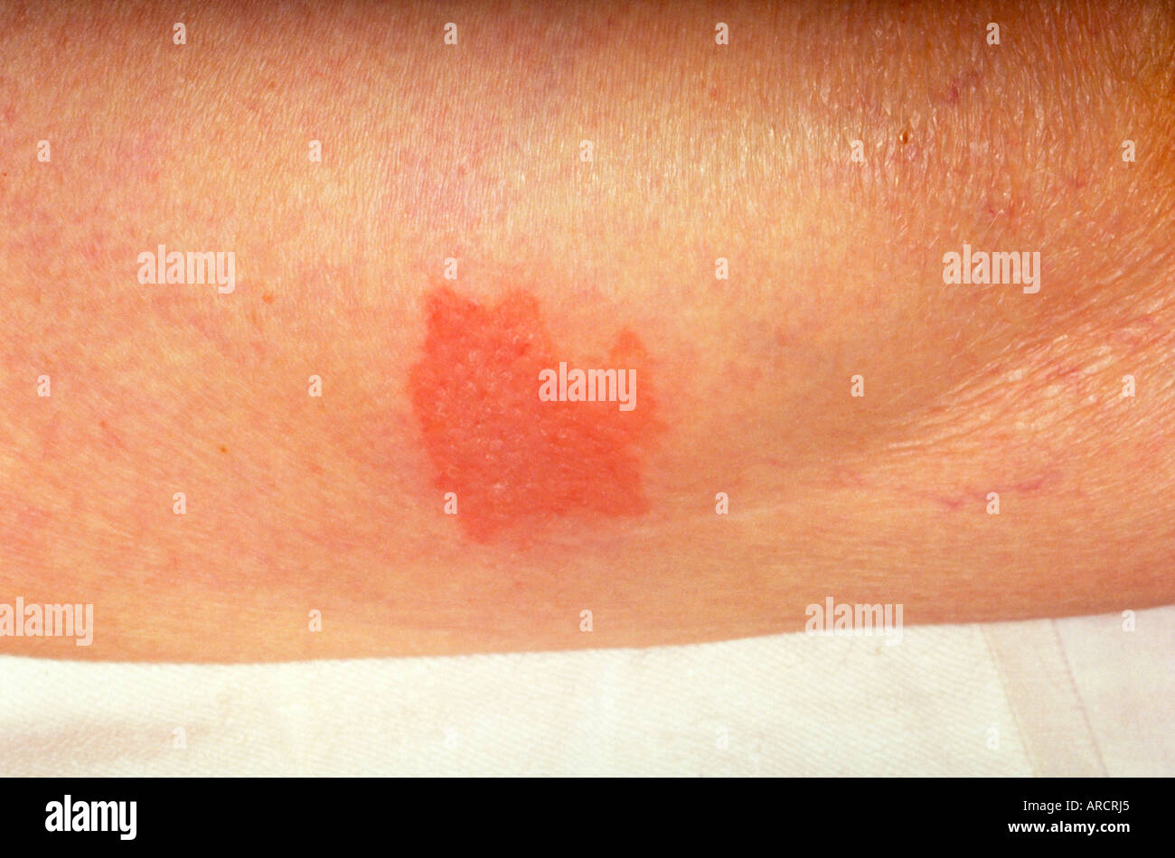 Bollose o vesciche farmaco eruzioni sono tra le più gravi tipi di reazioni avverse al farmaco. Foto Stock