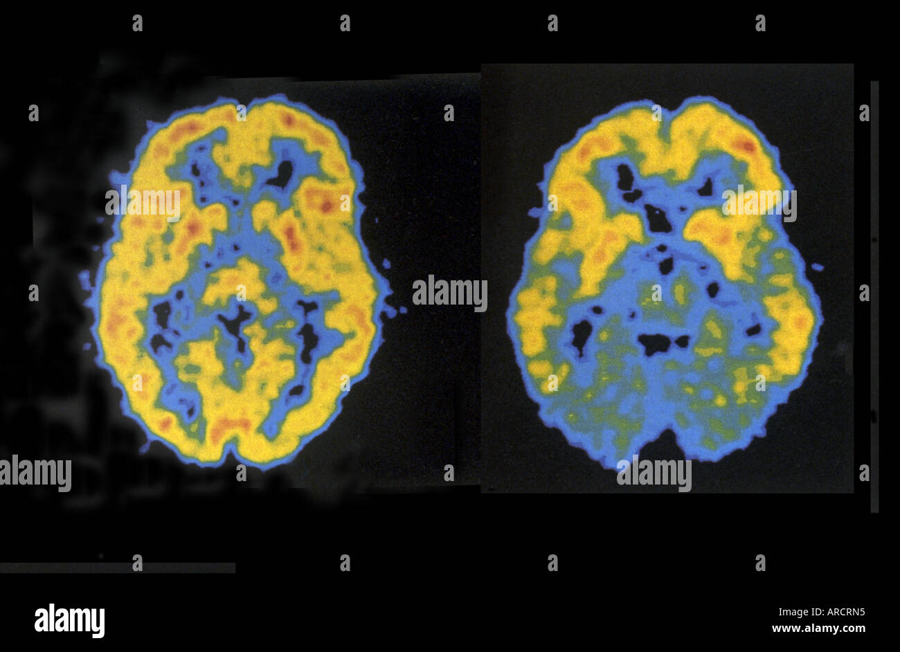 Una coppia di scansioni PET mostra il normale (sinistra) e ridotta (destra) attività cerebrale. Foto Stock