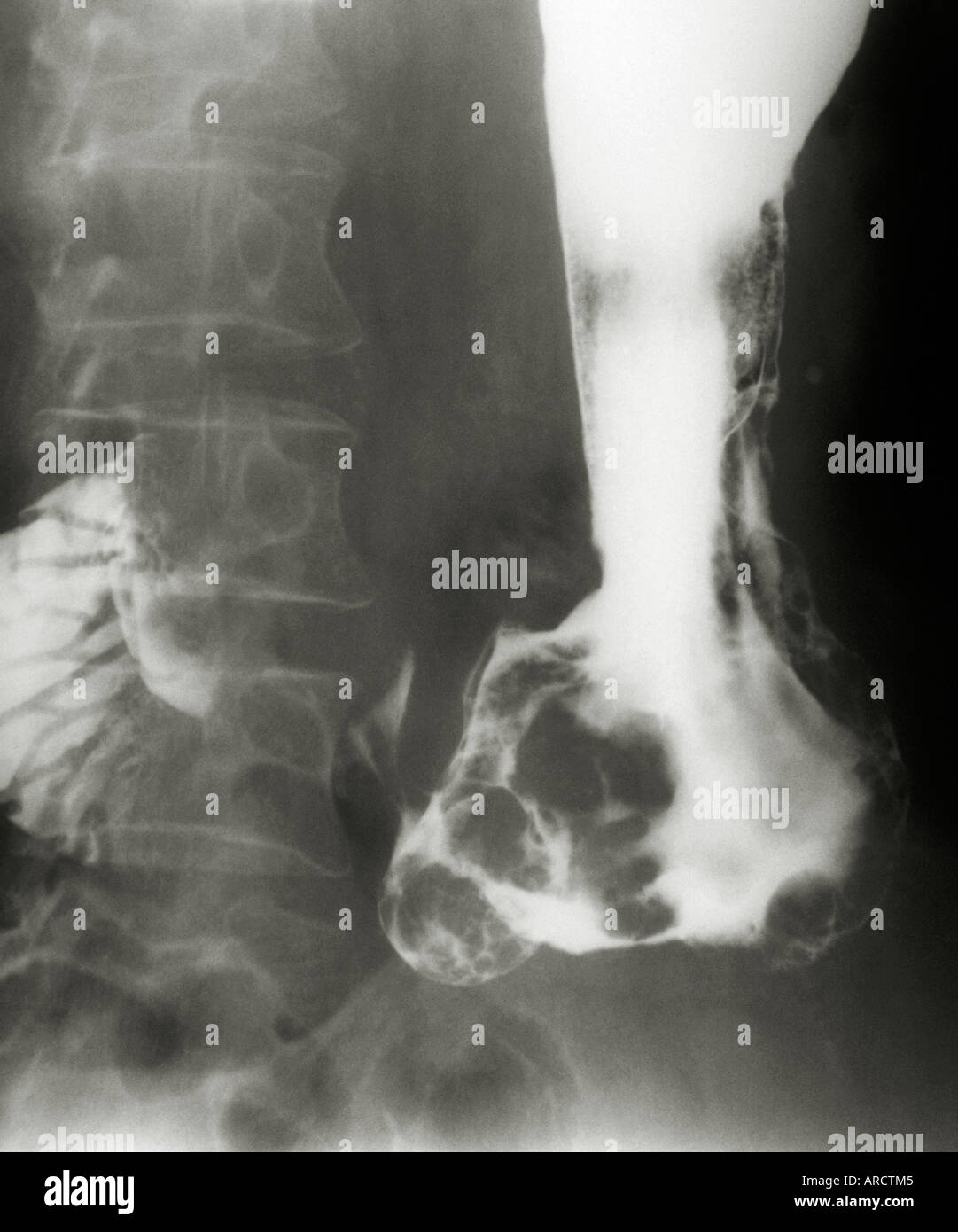 Un x-ray con bario conrast medie che mostra un tumore allo stomaco. Foto Stock