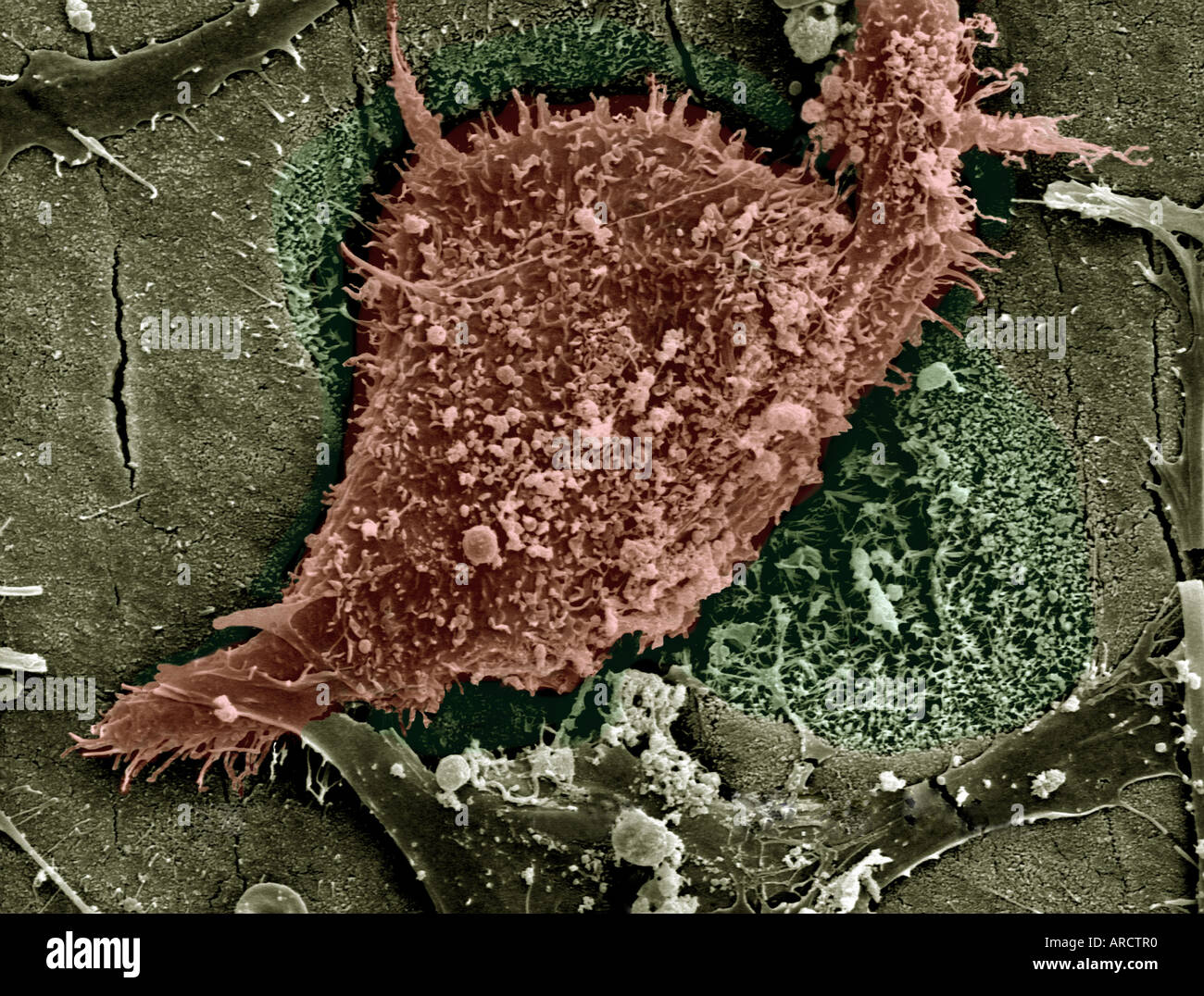 Una micrografia al microscopio elettronico a scansione di un riassorbimento degli osteoclasti osso, ingrandite x1000. Foto Stock