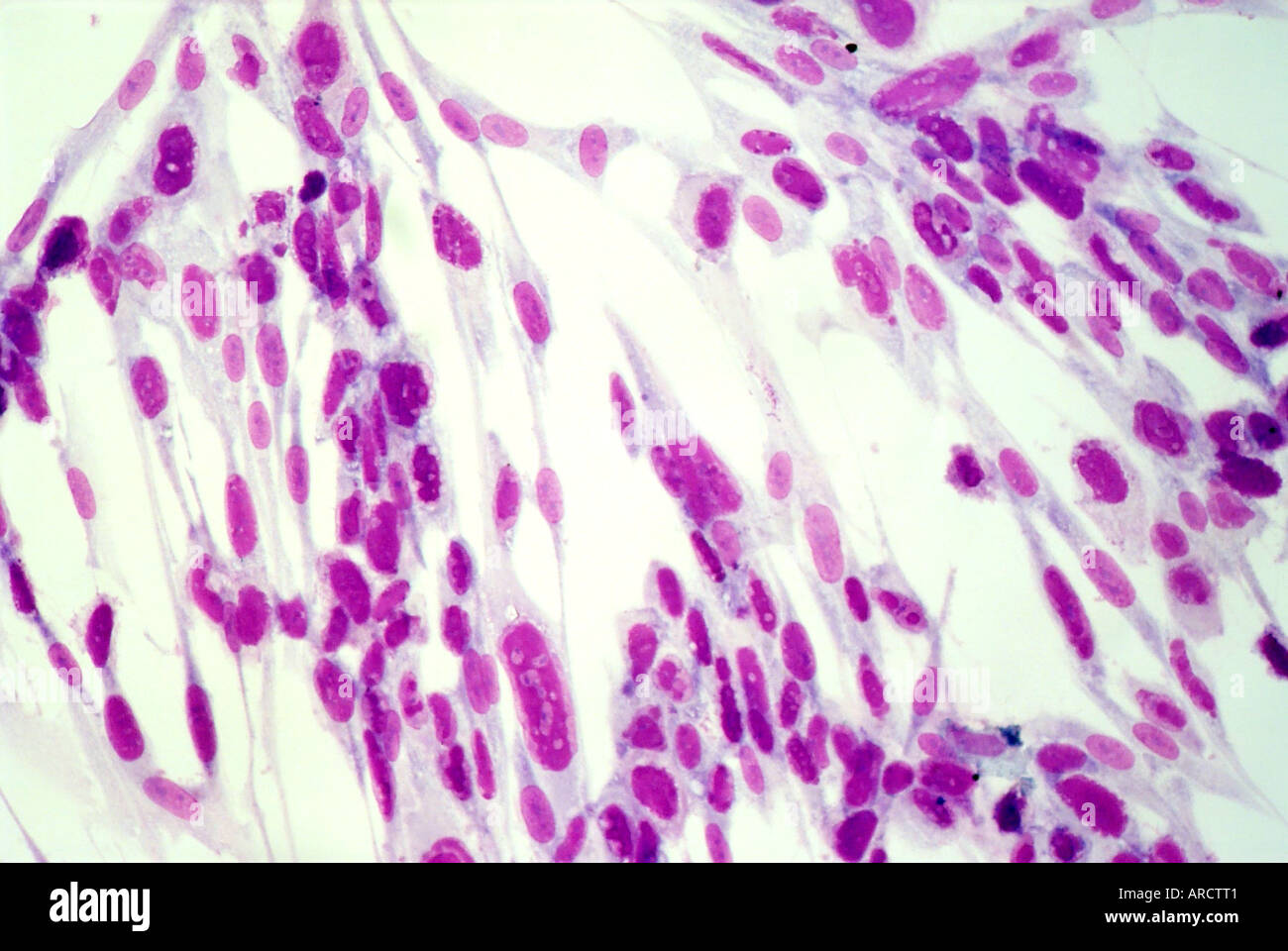 Umana coltivati in vitro di fibroblasti primari che mostra un tipico effetto citopatico dovuta alla infezione di coltura cellulare. Foto Stock