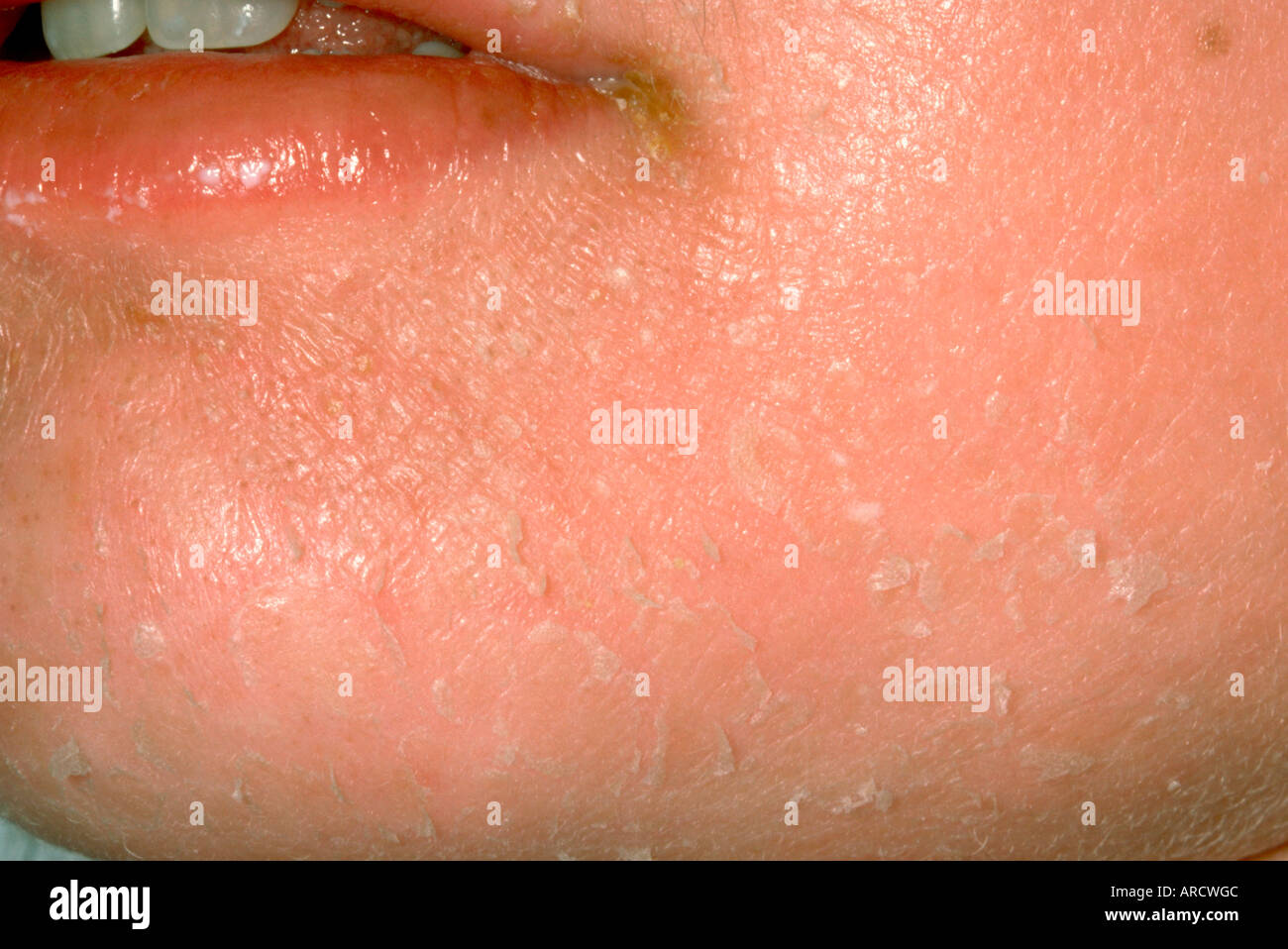 La sindrome da shock tossico Foto Stock
