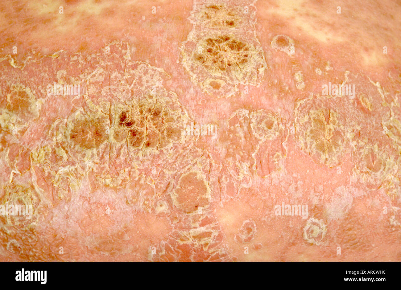 Close up fotografia di psoriasi a placche, un comune la malattia della pelle infiammatoria. Foto Stock