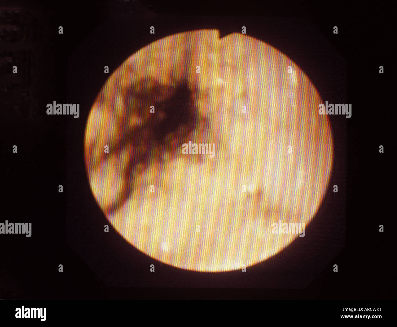 Una fotografia scattata attraverso un endoscopio durante un esame della tomaia tratto gastrointestinale (GI). Foto Stock