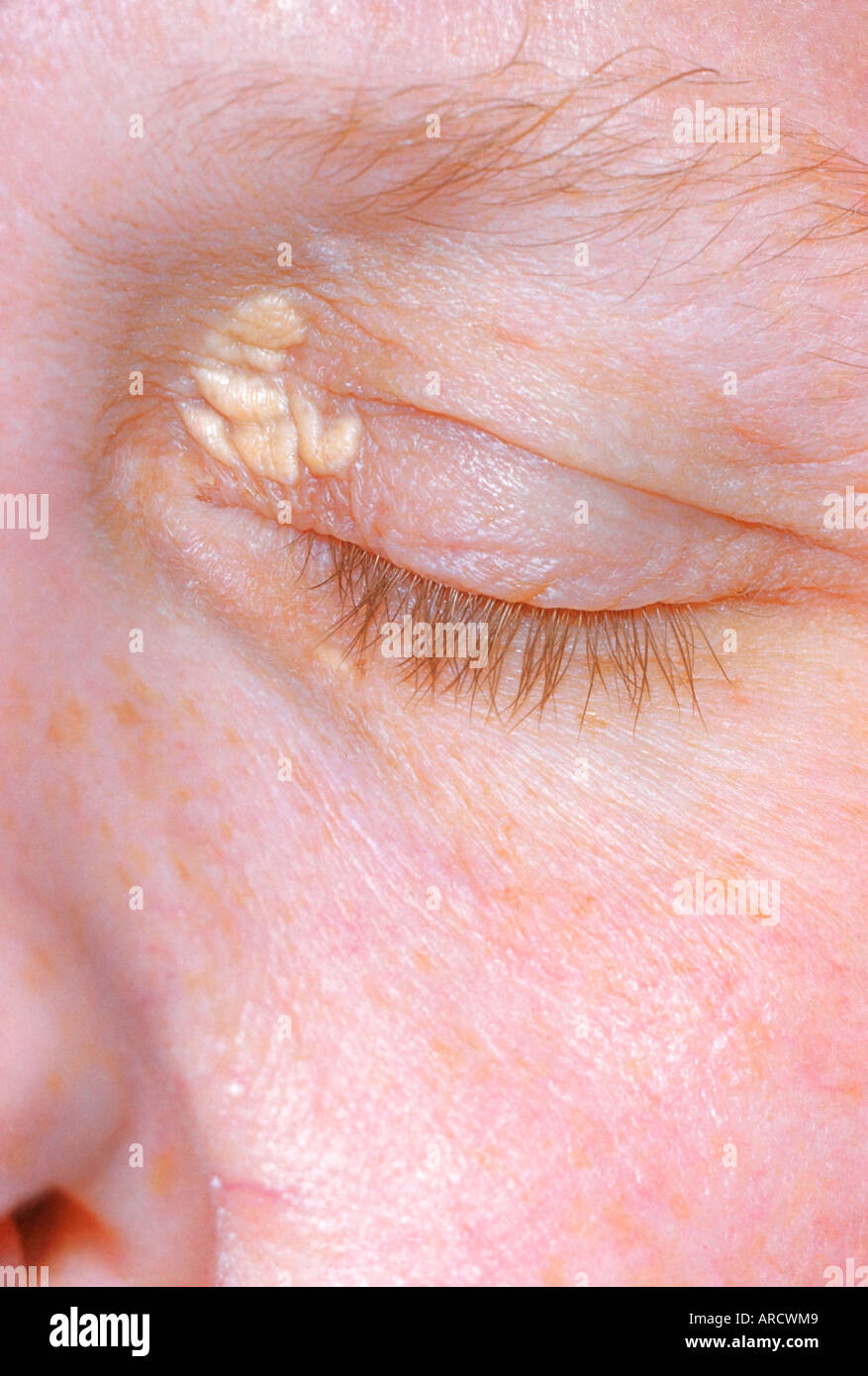 Xanthomatosis è una condizione in cui il grasso si deposita e si verificano in varie parti del corpo. Foto Stock