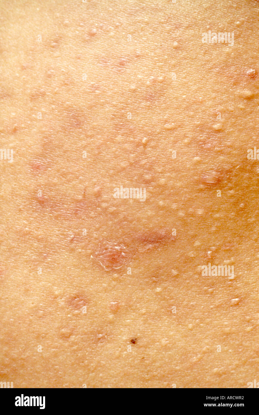 Una fotografia di acne vulgaris, il tipo più comune di acne. Foto Stock