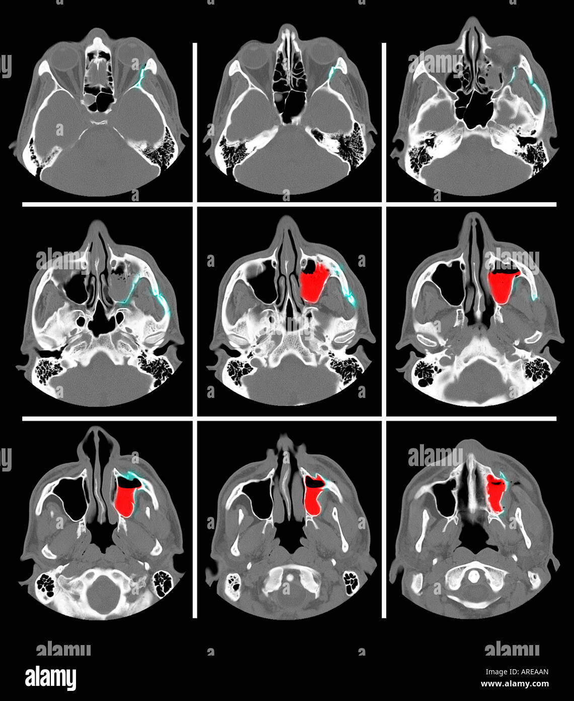 Scansione TC mostra una frattura mascellare Foto Stock