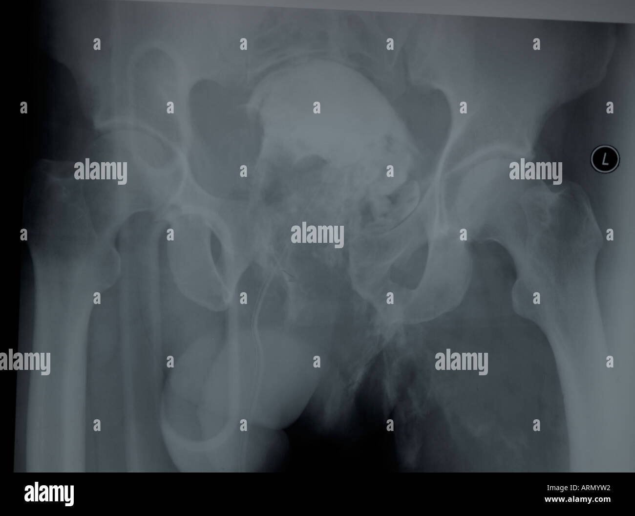 X-ray di gross libro aperto frattura della Pelvi maschile Foto Stock