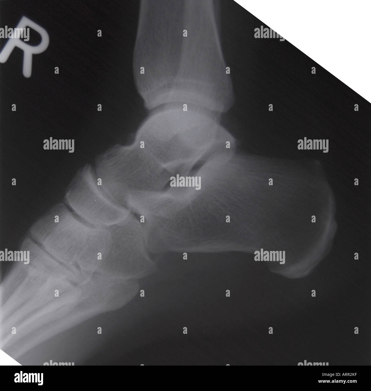 Il normale radiogeno laterale della caviglia per adulti Foto Stock
