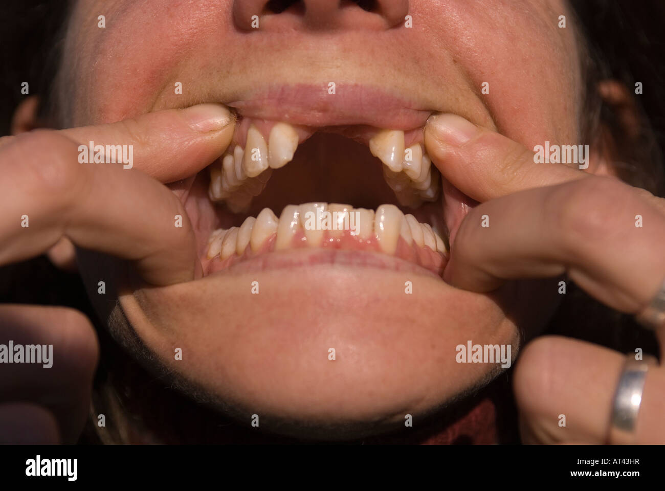 Close up donna mancanti di denti frontali Foto Stock