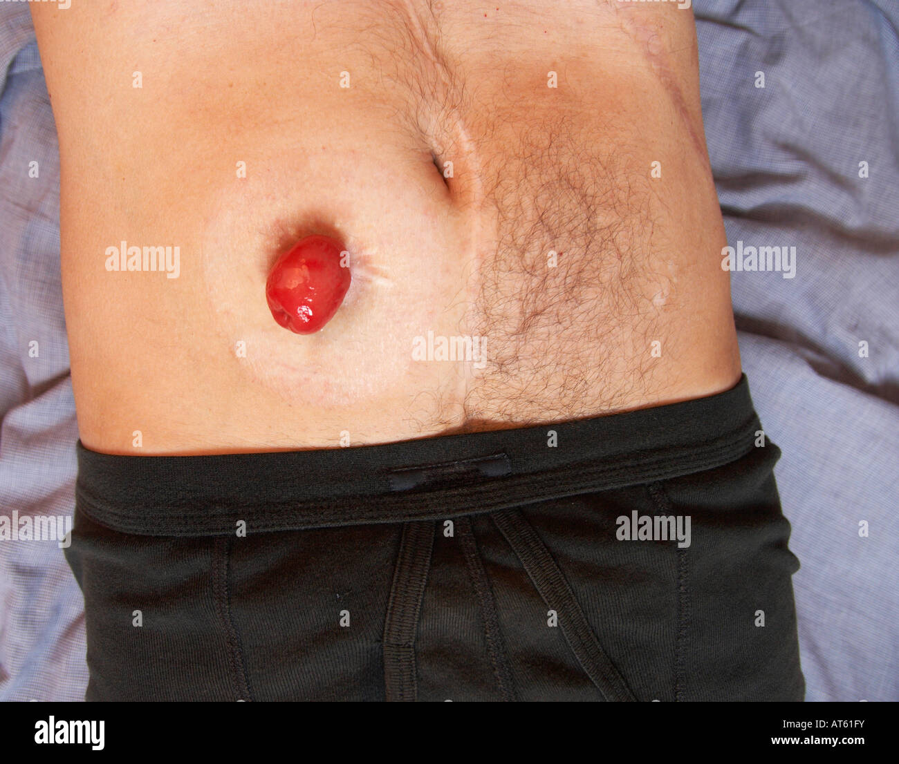 Cinquanta anni di maschio con ileostomia stoma Foto Stock