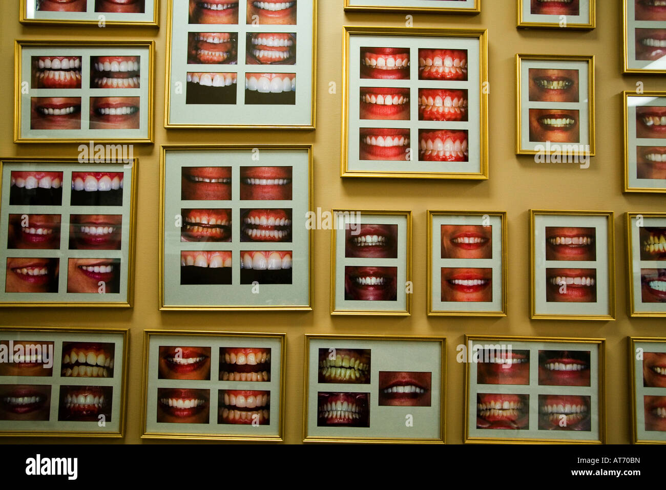 Visualizzazione dei denti in studio dentistico che mostra il prima e il dopo le foto seguendo le procedure dentistiche Foto Stock