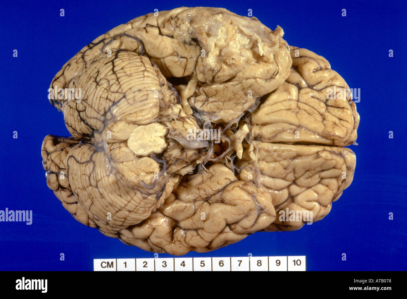 Cervello glioma del campione Foto Stock
