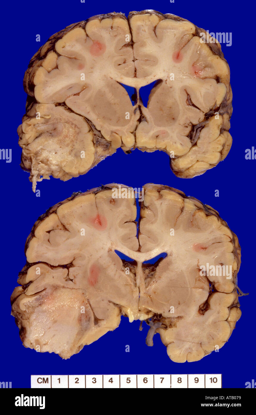 Sezioni di cervello glioma Foto Stock