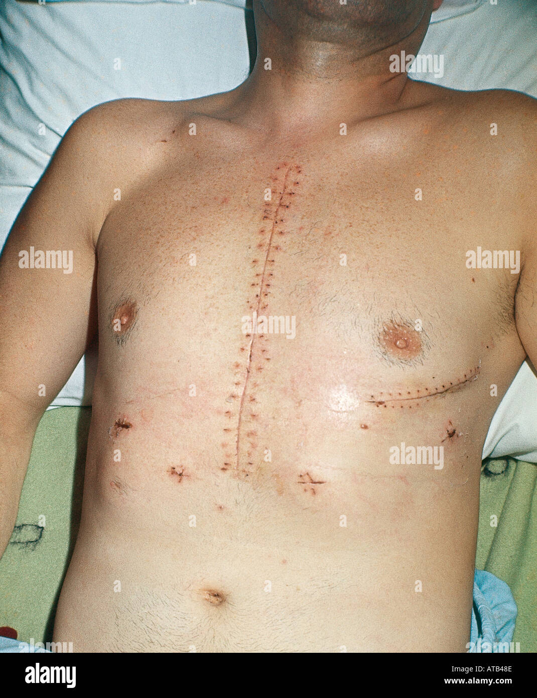 Sternotomy cicatrice Foto Stock