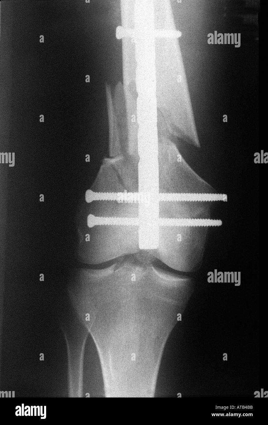X ray femore fratturato con supracondylar chiodo Foto Stock