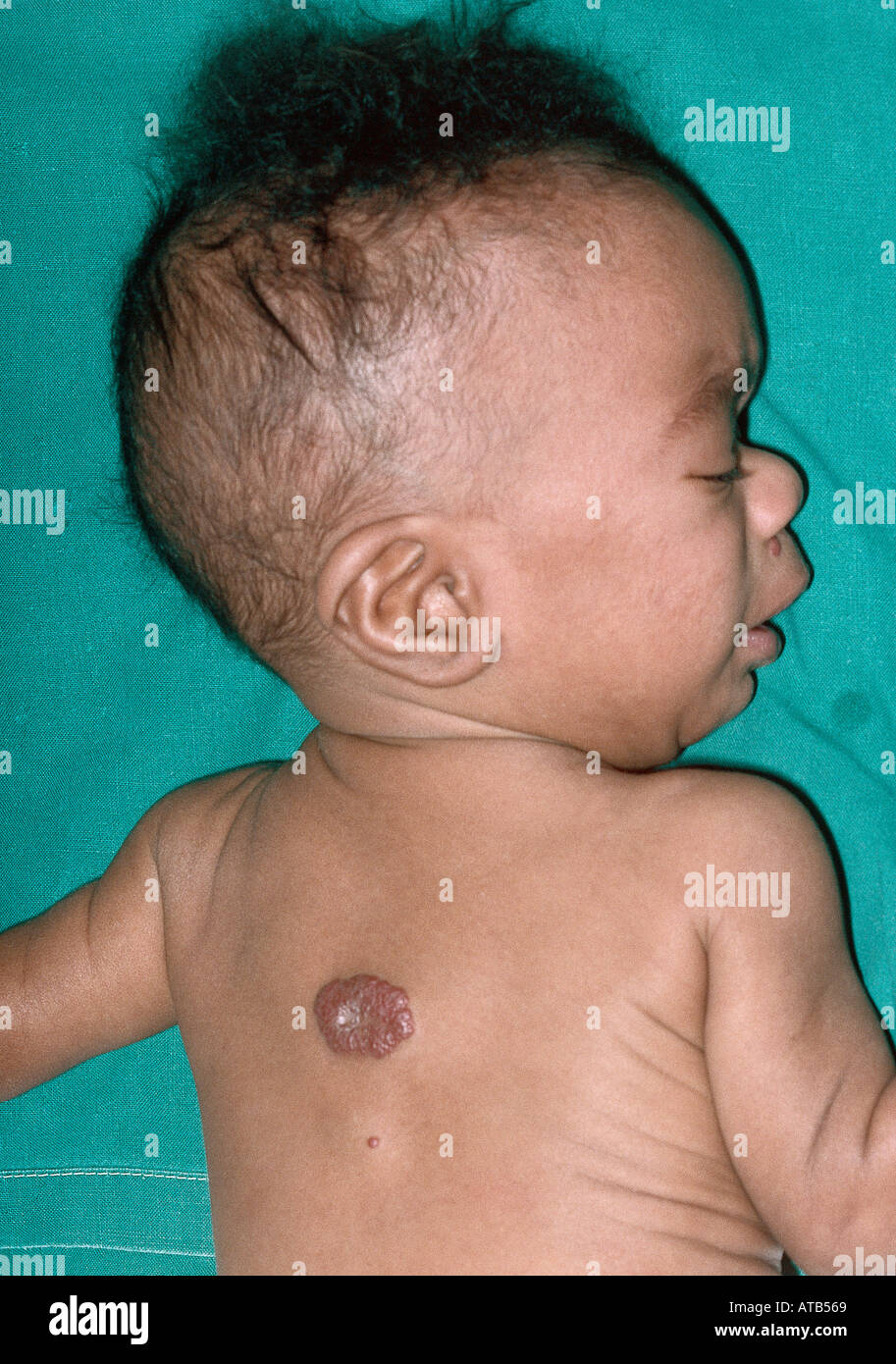 Sindrome alcolica fetale bambino immagini e fotografie stock ad alta