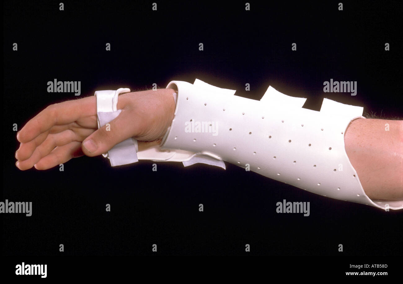 Colles Frattura polso Orthoplast splint Foto Stock