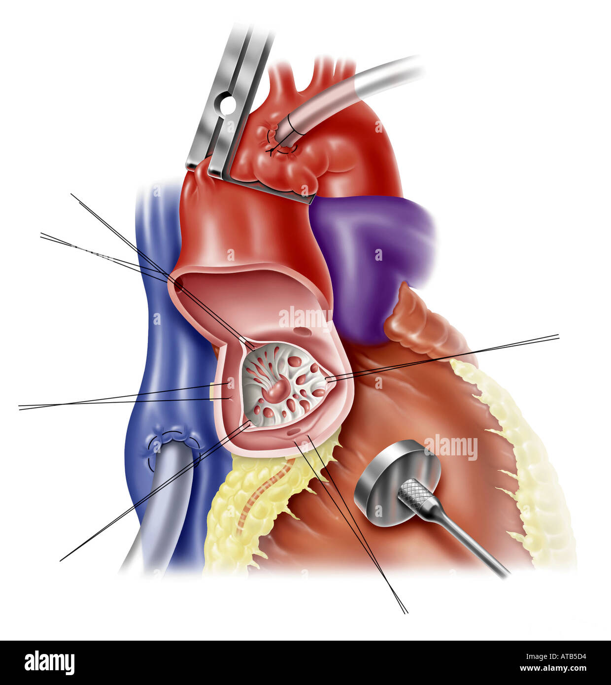 Illustrazione - sostituzione di valvola aortica Foto Stock
