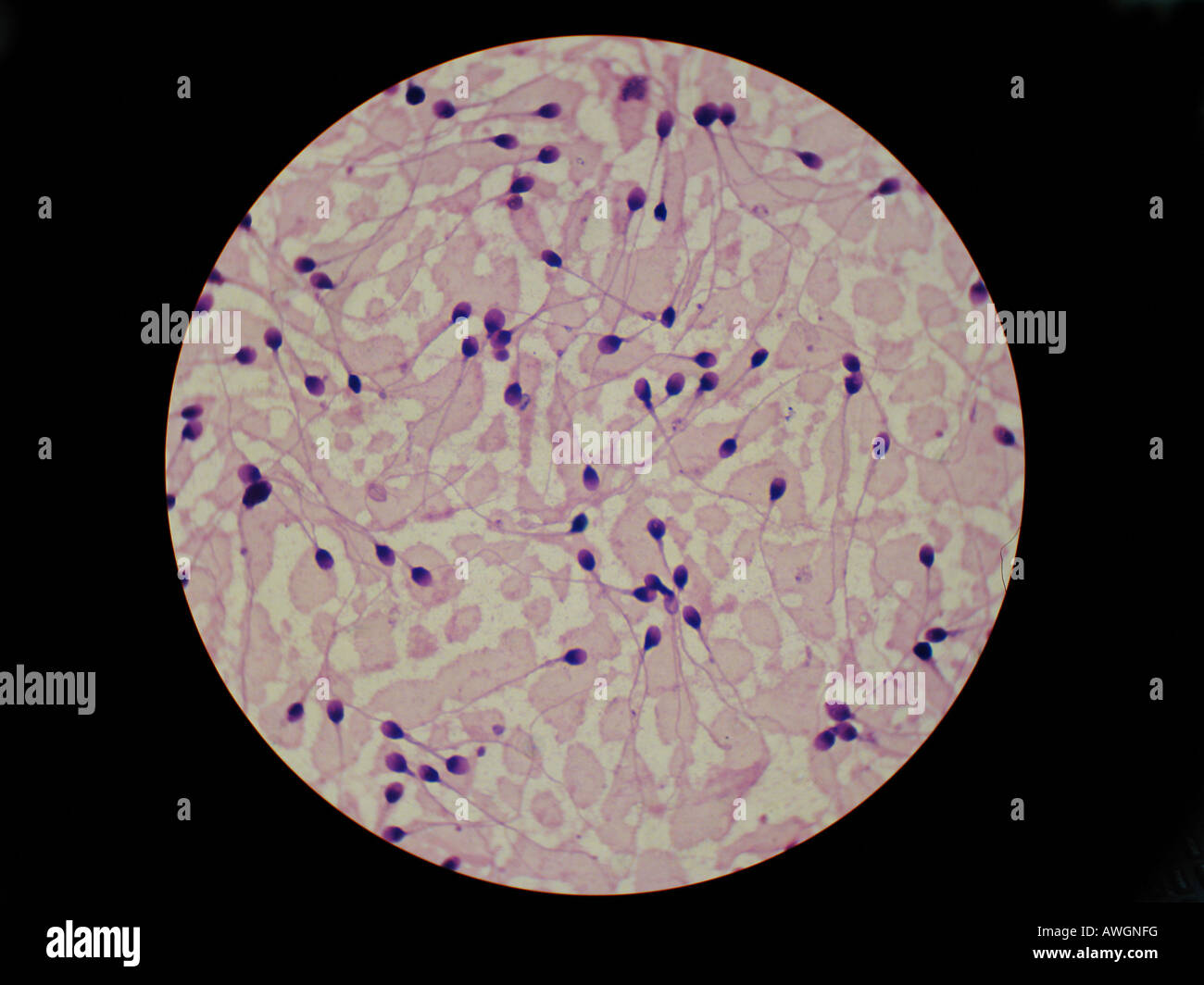 Sperma, macchia di morfologia al microscopio a 100 x olio inmersion obiettivo Foto Stock