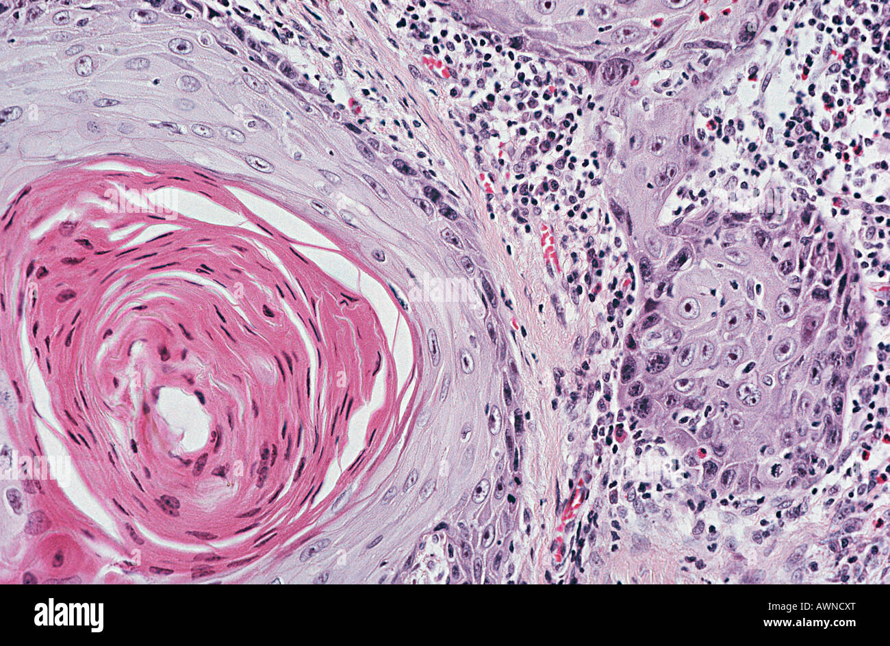Il carcinoma a cellule squamose Foto Stock
