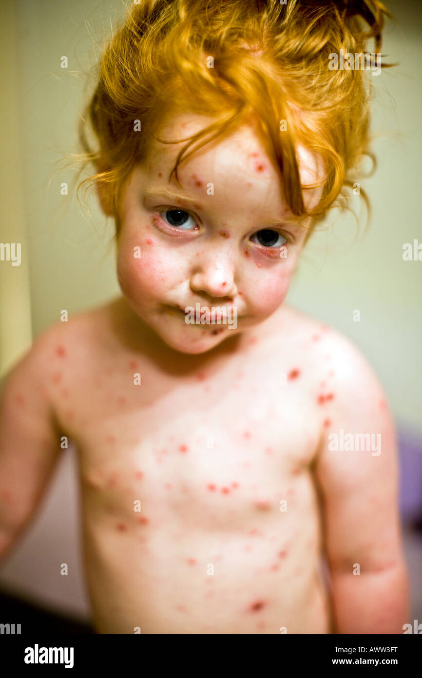 Bimba di tre anni coperti con la varicella spot Foto Stock