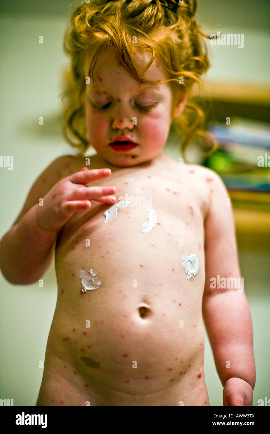 Bambina di tre anni con la varicella di ispezionare il suo spot Foto Stock