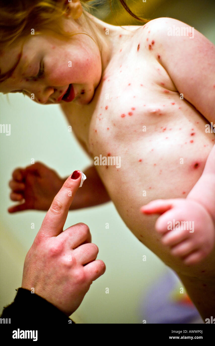 Bambina di tre anni con la varicella avente la crema applicata dalla sua madre Foto Stock
