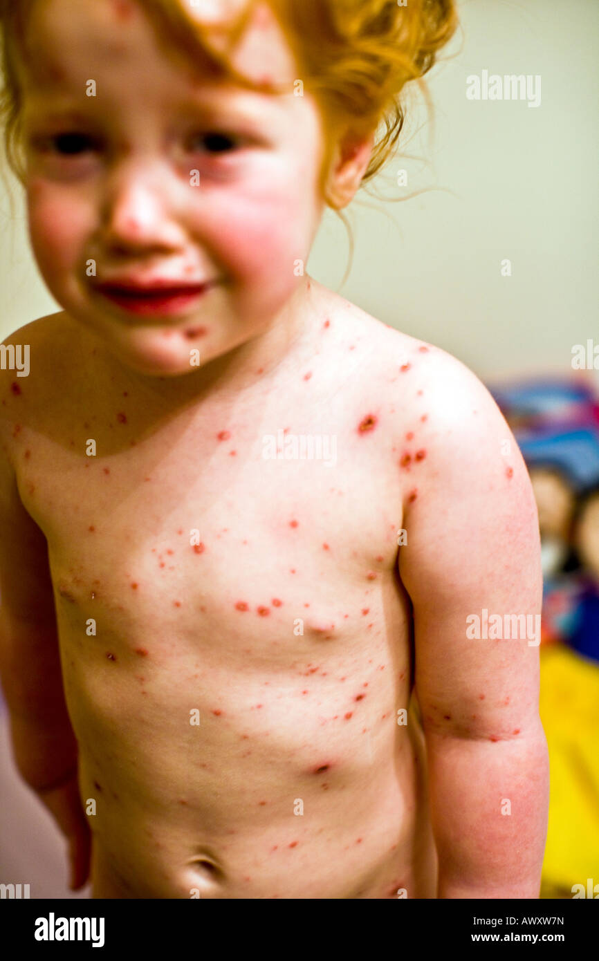 Bimba di tre anni coperti con la varicella rash Foto Stock