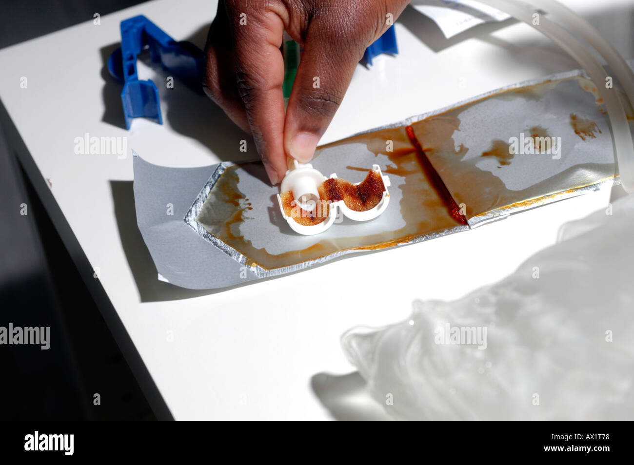 Sacchetto CAPD exchange Foto Stock