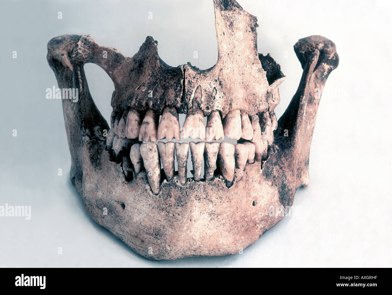 Cranio da un quinto secolo d.c. tomba sepoltura mostra mutilazione dentale che denota lo stato di alta. Foto Stock