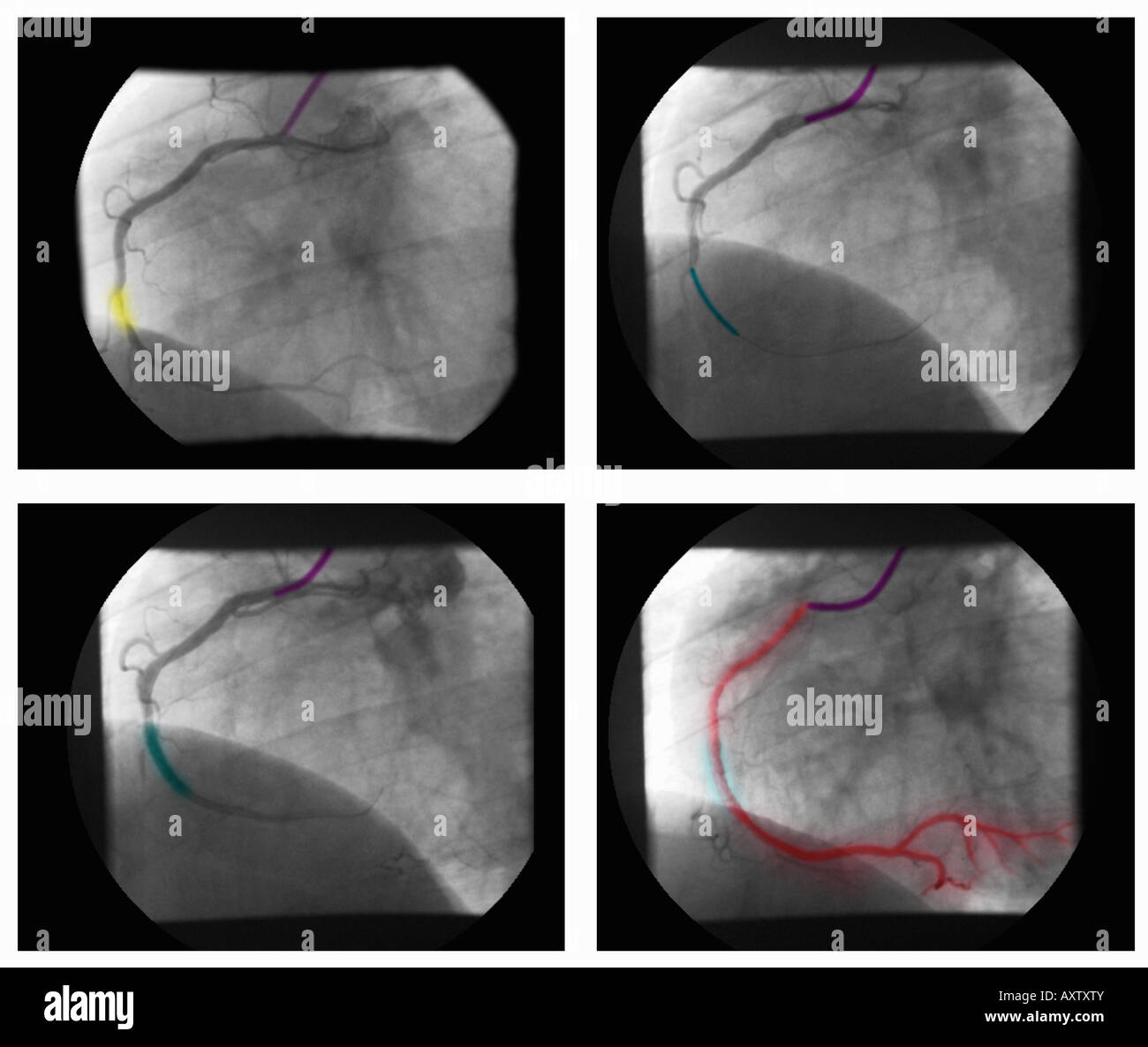Serie di formato digitale avanzata, raggi x di un angiogramma coronarico che mostra la stenosi e stenting della coronaria destra Foto Stock