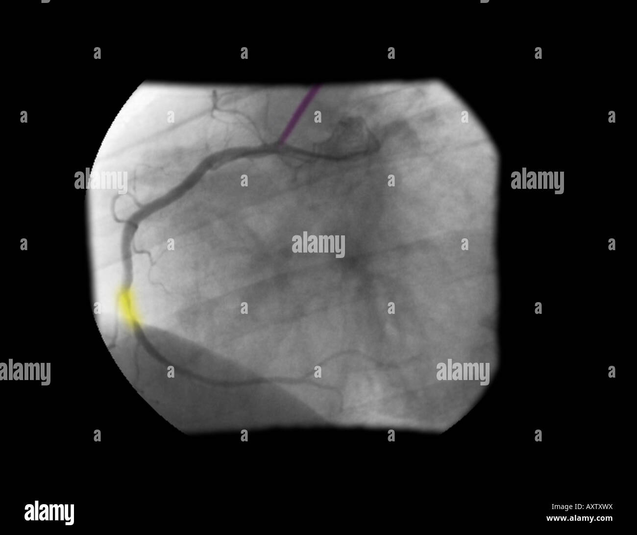 In modo digitale avanzata, colorizzato raggi x di un angiogramma coronarico la stenosi dell'arteria coronaria destra Foto Stock